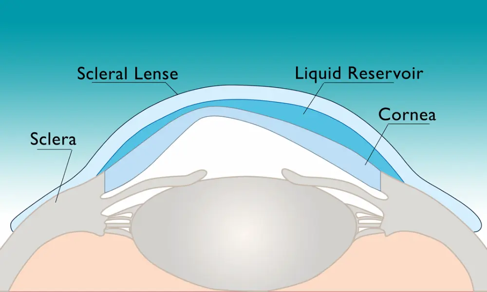 lenses