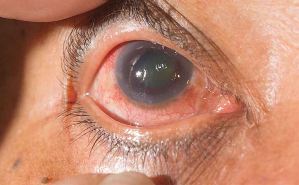 Glaucoma